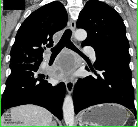 Metastatic Renal Cell Carcinoma To Mediastinum Lung And Adrenals