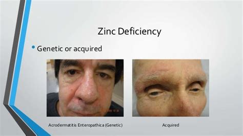 Mmps And The Role Of Zinc In Wound Healing
