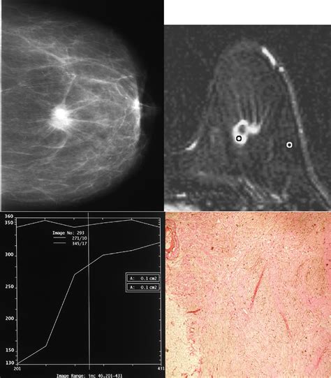 Malignant Spiculated Breast Masses Dynamic Contrast Enhanced Mr Dce