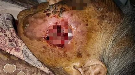 Surgeons Remove 50 Live Maggots From Pensioners Face In Extremely Rare