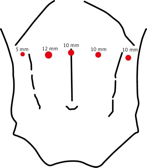 Placement Of Trocars Download Scientific Diagram