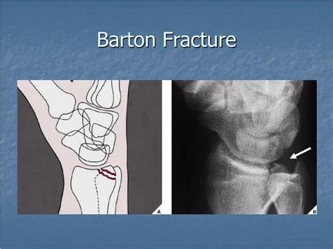 Ppt Distal Forearm Fractures And Dislocations Powerpoint Presentation