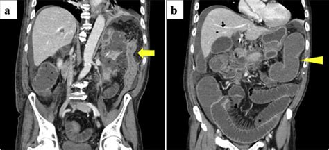 Contrast Enhanced Abdominal Computed Tomography Scan Revealed A