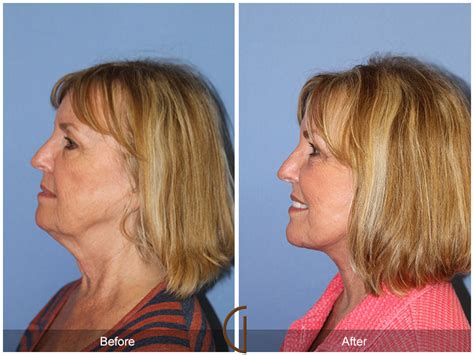 Neck Lift Before And After Photos Patient 38 Dr Kevin Sadati