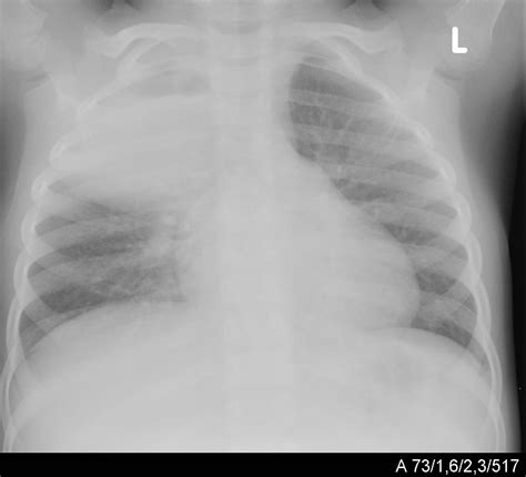 Pneumonia In Children Intechopen