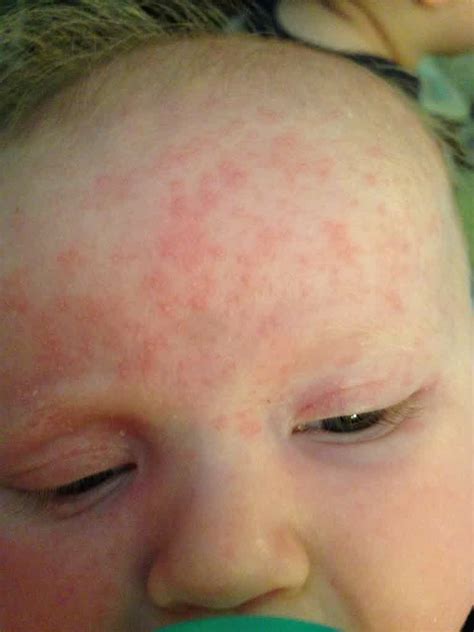 Rash On Baby Forehead Pictures Photos