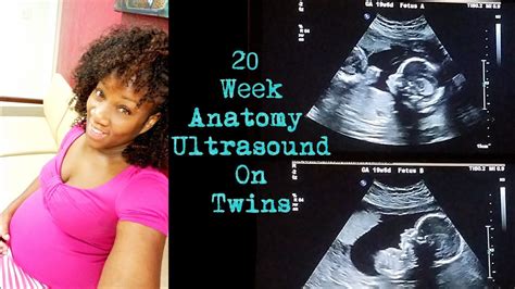 20 Week Twin Pregnancy Update And Anatomy Ultrasoundscan Youtube