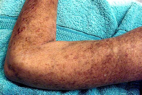 The Different Types Of Scleroderma Systemic Sclerosis
