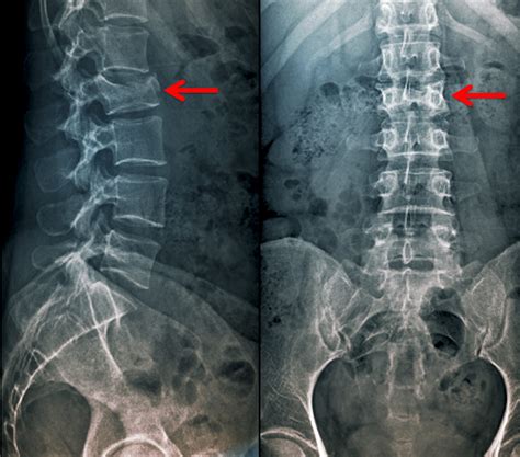 Thoracic Burst Fracture Treatment Eshealthtips