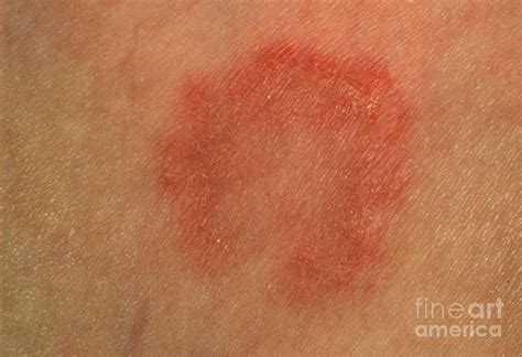 Tinea Corporis Ringworm Lesion On Skin Photograph By Dr Chris Hale