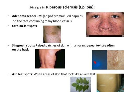Medical Tuberous Sclerosis Orange Peel Texture Medical