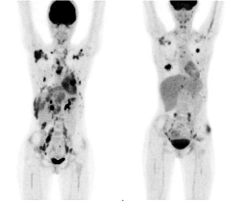 18 F Fdg Petct For The Evaluation Of The Response To Chemotherapy In