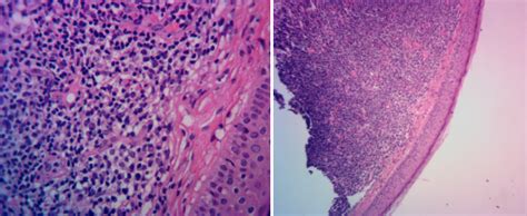 Cutaneous B Cell Lymphoma Of The Ear Skin Cancer And Reconstructive