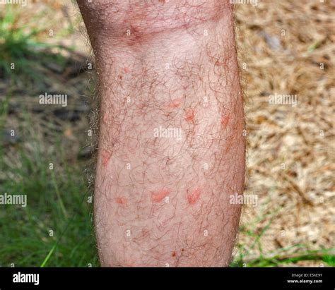 Mosquito Bites Leg Hi Res Stock Photography And Images Alamy