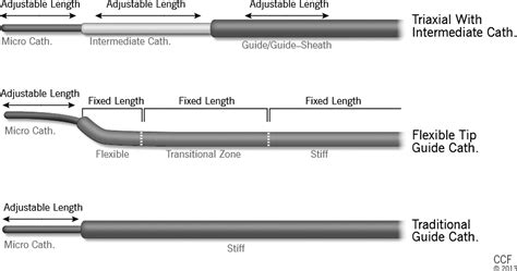 Flexible Tip Guides And Intermediate Catheters Two Center Experience