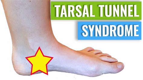 Tarsal Tunnel Syndrome Treatment And Diagnosis Youtube