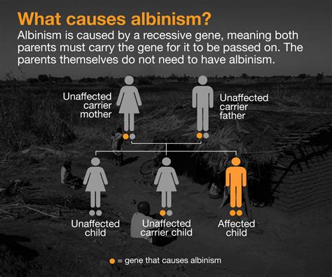 What is albinism and what causes it? | Infographic News | Al Jazeera