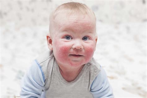Mayo Clinic Minute Protecting Babies From Eczema Risk Mayo Clinic