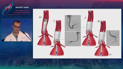 Results Of The Tambe Phase One Trial For The Treatment Of Juxtrarenal