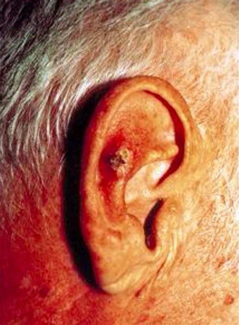 Squamous Cell Carcinoma Nejmorg Dr Mustapha Tahir Ear Diseases