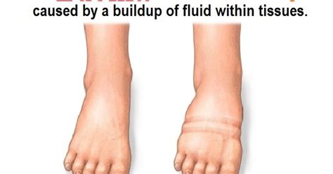 What Is The Difference Between Pitting Edema And Non Pitting Edema