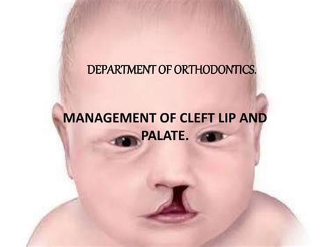 Management Of Cleft Lip And Palate Ppt