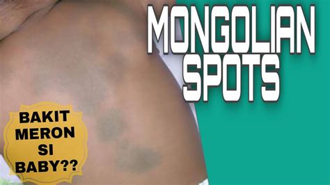 Mongolian Spots Black Patches Or Spots On Baby Tagalog Youtube