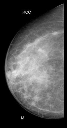 Breast Microcalcifications Screening Mammogram Radiology Case Radiopaedia Org