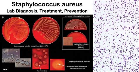 Staphylococcus Aureus Lab Diagnosis Treatment Prevention