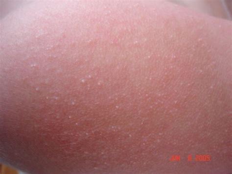 Common Skin Rashes On Arms Pictures Photos
