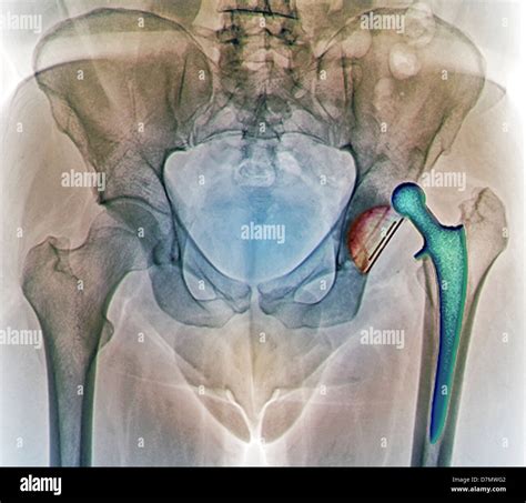 Dislocated Hip Replacement X Ray Stock Photo Alamy