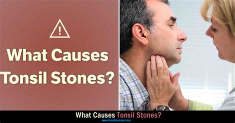 What Causes Tonsil Stones 2022