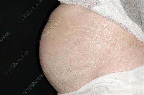 Ascites Distended Abdomen In Cancer Stock Image C008 5714 Science Photo Library