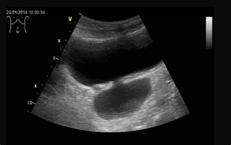 Urethral Diverticulum Ultrasound