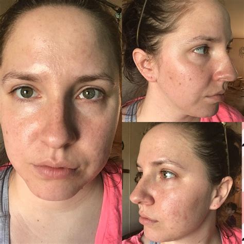 Routine Help Skin Started As Dry And Dehydrated Dryness Is Leveling