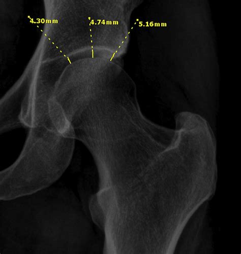 No Differences In Hip Joint Space Measurements Between Weightbearing Or