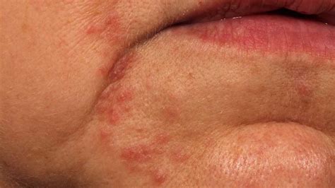 Flaky Skin On Face Around Mouth Red Rash Around Your Mouth Could Be Perioral Dermatitis Here