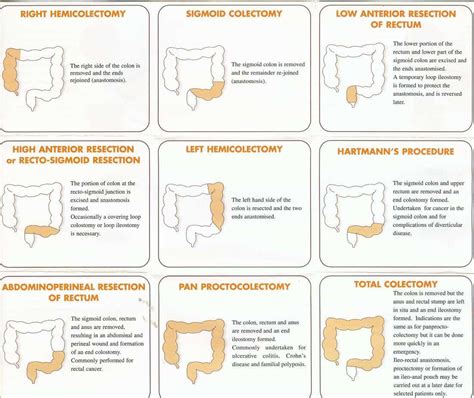 The Different Types Of Colonic Resection Dr Matt W Johnson Bsc Mbbs