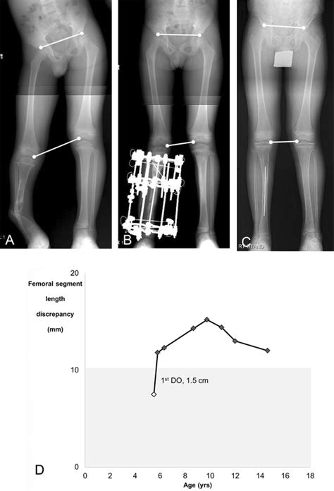 Femoral Overgrowth In Children With Congenital Pseudarthrosis Of The