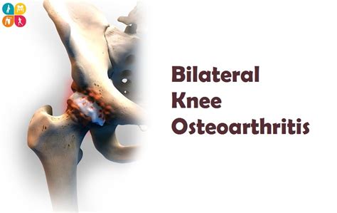 Bilateral Knee Osteoarthritis Everything That You Wanted To Know