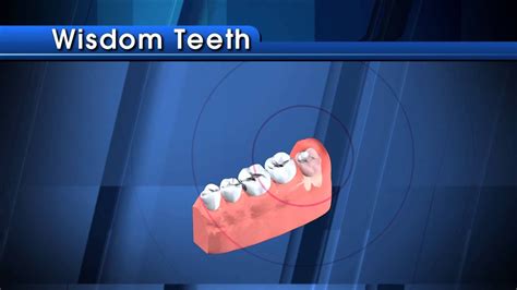 symptoms and signs that your wisdom teeth are coming in boston dentist congress dental group