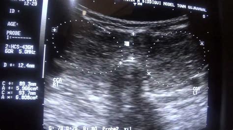 Ultrasound Thyroid Diffuse Goiter Youtube
