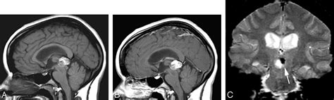 Mr Imaging Of Papillary Tumor Of The Pineal Region American Journal