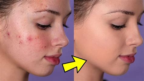 How To Hide Pimples Without Makeup Saubhaya Makeup