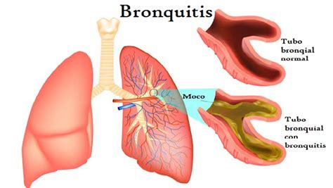 Bronquitis Qué es síntomas recomendaciones Atención Méd