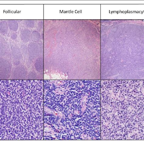 The Histology Of Low Grade B Cell Lymphomas At Â4 And Â40