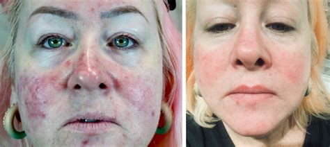 Rosacea Before And After Beauty And The Brows