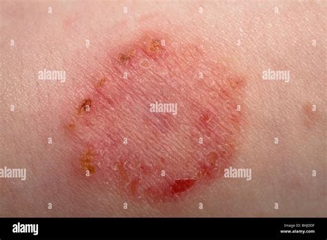 Tinea Corporis Ringworm Lesion On Skin By Chris Halescience Photo