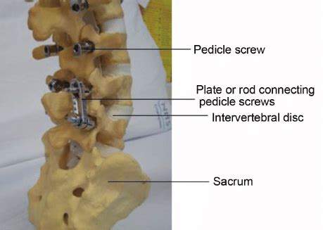 Pedicle Screws Are Inserted Posteriorly Through The Pedicles Into The Download Scientific