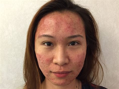 Dr Gerard Ee Clifford Agnes The Permanent Cure For Adult Acne